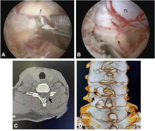 Figure 4 (A) Flavectomy. (B) Root mobilization and discectomy. (C) Post foraminotomy 2D axial CT Image. (D) Post foraminotomy 3D CT Image. Black arrows point on decompression site.