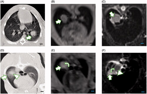 Figure 3. Comparison of imaging features of the VX2 tumor on CT and MRI pre- and post-MWA (scale bar = 1 cm). (A) The VX2 tumor was successfully implanted in the left lower lobe of the lung (arrow). (B) On 3D-VIBE-T1WI image, the tumor showed isointensity as compared with muscle (arrow). (C) On FS-TSE-T2WI image, the tumor showed hyperintensity as compared with muscle (arrow). Lung texture was barely visible on either 3D-VIBE-T1WI or on TS-FSE-T2WI image. (D) After the ablation, ground-glass opacity (arrow) was seen covering the tumor (triangle), and the border of the tumor was vague. (E) The tumor showed high signal intensity on 3D-VIBE-T1WI image after ablation (arrow) with a small area of centered isointensity (curve arrow). (F) The signal decreased on TS-FSE-T2WI image post-ablation (triangle). The ablation area demonstrated central low signal intensity, which corresponded to the thermally coagulated area in the pathological examination. The central area was surrounded by a high signal intensity rim (curve arrow) that could possibly correspond to the effusion area, while the outermost area showed higher signal intensity that could correspond to the congestion area (arrow).