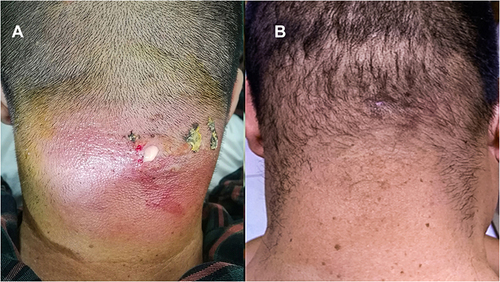 Figure 2 Patient 2: (A) lesion before fire needle treatment. (B) lesion after 21 days of fire needle treatment.