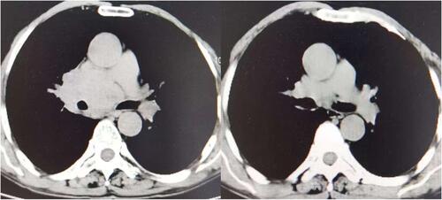 Figure 3 The CT scan results for the changes of target lesions in one elderly patient with non-small cell lung cancer before and after the treatment of anlotinib [follow-up date: December 5, 2018 (left) and March 4, 2019 (right)].