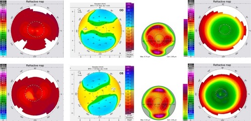 Figure 3 OD and OS Topolyzer topography scans pre-op, Pentacam anterior elevation pre-op, HOAs pre-op, post-op 10 months Topolyzer scans for Sample case 3.