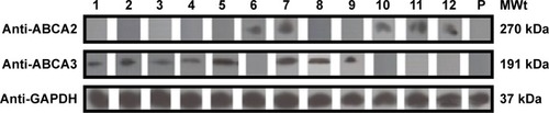 Figure 2 ABCA2 and ABCA3 protein expression of samples with a high ABCA2/ABCA3 mRNA expression.