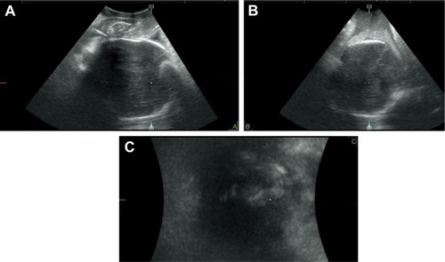 Figure 8 A multiplanar view of three-dimensional transperineal volume performed in labor.