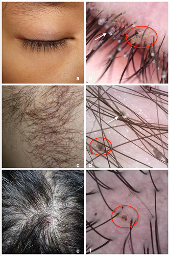 Figure 1 Examinations of three clinical cases with the Pthirus pubis infection involved in eyelashes (a and b), axillary region (c and d) and head (e and f), respectively. (a) Slit-lamp microscope examination. (b) Dermoscopy examination. (c) Skin examination. (d) Dermoscopy examination. (e) Scalp examination. (f) Dermoscopy examination. Red circles, pubic lice bodies; White arrows, lice eggs.