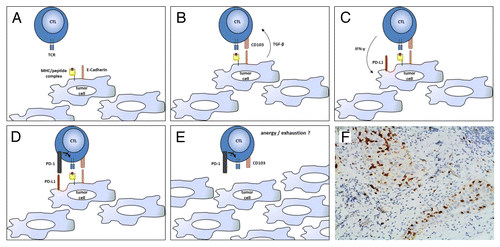 Figure 1. CD103+ lymphocytes infiltrating human ovarian carcinoma. (A–E) Ovarian cancer-infiltrating lymphocytes (TILs) express CD103 in response to tumor-associated antigen (TAAs) and transforming growth factor-β (TGF-β). CD103+ tumor-infiltrating lymphocytes (TILs) efficiently control tumor growth for a while, but then become trapped within neoplastic lesions as a consequence of CD103 expression, eventually becoming exhausted (PD-1+) owing to chronic antigen stimulation. (F) CD103+ TILs in a high-grade serous ovarian cancer specimen obtained from cytoreductive surgery. The section was stained with an anti-CD103 rabbit monoclonal antibody (Epitomics clone EPR4166Citation2), an anti-rabbit horseradish peroxidase-conjugate antibody and diaminobenzidine (DAB). CD103+ TILs (stained in brown) can be seen clustering within epithelial tumor regions. CTL, cytotoxic T lymphocyte; IFNγ, interferon γ; PD-L1, PD-1 ligand 1; TCR, T-cell receptor.