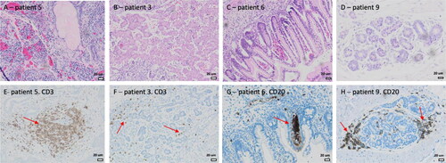Figure 4. Immunohistochemical identification of lymphocytes in and around glandular and acinar epithelial elements in SCTs. A-D, Hematoxylin-eosin (HE) staining. E-H, Immunohistochemical staining for CD3+ T-lymphocytes (E and F) and CD20+ B-lymphocytes (G and H) show clusters in and around epithelial glandular and tubular structures (red arrows).