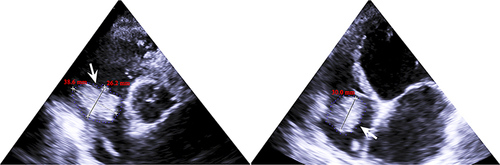Figure 1 Echocardiography of the patient. White arrow represents a 38.6×26.2×30.0 mm vegetation adhered to right cardiac pacemaker.