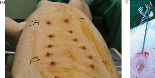 Figure 3. Swine, 525 lbs, prepared for CITT ablation. The nipples were numbered 1–15, to indicate the site of ablation at each point of time (A). The CITT probe is positioned inside the simulated lumpectomy cavity (B).