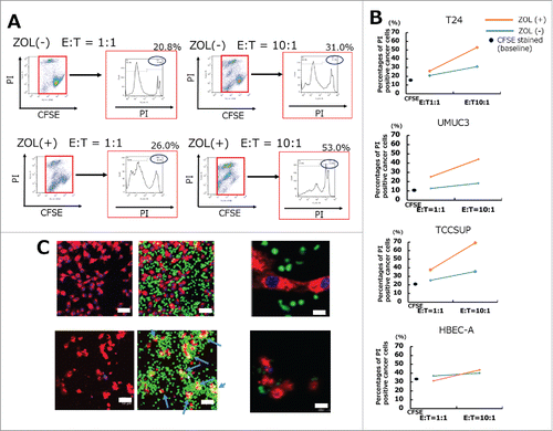 Figure 2. In vitro cytotoxicity assays demonstrated that UBC cells were lysed by human Vγ9Vδ2 T cells. (A) UBC and UB cells were stained with 0.5 μM CFSE and stimulated with or without 5 μM ZOL overnight. Results of typical flow cytometric analysis of γδT cell cytotoxicity in the T24 cell line are shown. (B) A summary of γδT cell cytotoxicity against several UBC cells and UB cells is shown. UBC and UB cells stained with CFSE 0.5 μM that were not co-cultured with γδT cells were used as the negative control. Cytotoxicity assays were performed in the absence (blue bars) or presence (orange bars) of 5 μM ZOL pretreatment. Black spots indicate the apoptotic percentages of CFSE stained baseline cancer cells. Mean value of triplicate wells is shown and representative data of three independent experiments are shown. (C) Imaging of cancer cells lysed by human γδ T cells using LSM 510. After 4 h of co-culture, γδT cells attached to cancer cells and lysed them by direct contact (blue arrows) (lower panels). Scale bars, 50 μm and 200 μm.