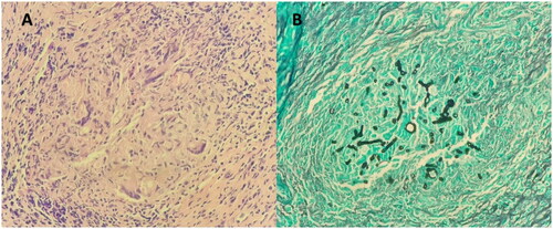 Figure 4. (A) Microscopic examination showed mucosal fragments stained with hematoxylin and eosin stain lined by respiratory mucosa. They are slightly polypoid in shape and show eosinophils surrounded by areas of lightly staining mucin sprinkled with Charcot-Leyden crystals (B) Tissue stained with grocott-–gomori methenamine silver highlights fungal elements. There are fungal elements seen within the granuloma. The fungus has slender septated hyphae, branching at an acute angle. No definite angioinvasion was observed.
