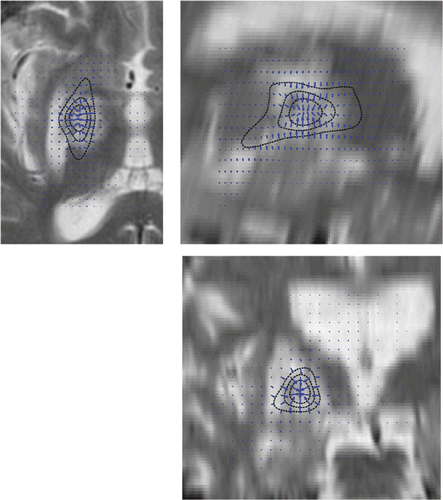 Figure 4. T2-weighted MRI axial (upper left), sagittal (upper right) and coronal (bottom) slices of the pallidotomy patient acquired 6 months post-treatment. The planned dose distribution (solid black lines; starting from the inside, these are the 120 Gy, 80 Gy and 40 Gy isodose lines) and the dose gradients (arrows) are also superimposed, allowing for a qualitative estimation of the clinical accuracy and related dose gradients of the treatment.