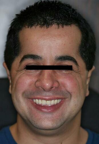 Figure 12 Final aspect of the patient with an improvement of esthetic appearance achieved with minimally invasive prosthetic approach.