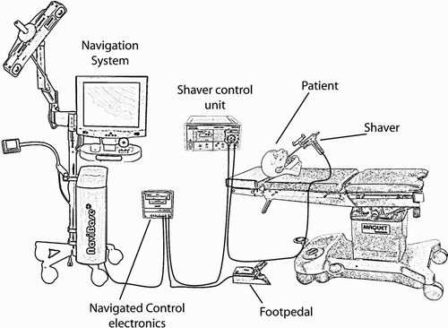 Figure 4. The system contains the following hardware components: navigation system, navigated control electronics, shaver control unit, foot pedal, shaver, and patient tracker.