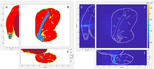 Figure 2. Representative segmented digital model and simulated pressure pattern. Segmented model (A) coronal, (B) sagittal, and (C) transverse views. Each rabbit was segmented with a semi-autonomous procedure into five tissues: muscle (red), fat (yellow), bone (blue), skin (green), and bowel (dark red), with all non-segmented voxels assigned as water. Focus location denoted with yellow “F.” Simulated ultrasound pressure pattern (D) coronal, (E) sagittal, and (F) transverse views superimposed on model outline. Pressure pattern was simulated using the hybrid angular spectrum technique. Pressure simulations used a radiating rear boundary and totally reflecting edges. Typical attenuation paths include 3 to 5 total pre-focus interfaces (water/skin, skin/muscle or skin/fat, and 0 to 4 amounts of muscle/fat interfaces), and general path lengths of 1 mm skin and 10 to 20 mm of ∼90–100% muscle and ∼0–10% fat.