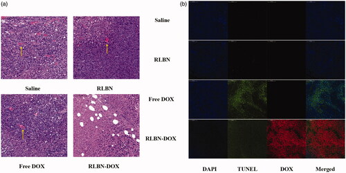 Figure 5. (a) H&E-stained histological sections of tumors on day 17 after intratumoral injection of saline, empty RLBN, free DOX and RLBN-DOX in xenograft-bearing mice. The yellow arrows indicate blood vessels (scale bar =100 μm). (b) DAPI staining (nuclei), TUNEL staining (apoptotic cells), red fluorescence (DOX) and merged images of tumors on day 17 after intratumoral injection of saline, empty RLBN, free DOX and RLBN-DOX in xenograft-bearing mice (scale bar =200 μm). H&E: hematoxylin and eosin; DAPI: 4',6-diamidino-2-phenylindole; TUNEL: terminal deoxynucleotidyl transferase dUTP nick end labeling; DOX: doxorubicin; RLBN: reversed lipid-based nanoparticles; RLBN-DOX: reversed lipid-based nanoparticles loaded with doxorubicin.