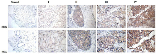 Figure 1 MTFR2 protein overexpression in archived breast cancer tissues examined by immunohistochemistry. Representative IHC images of MTFR2 expression in normal human breast vs breast cancer tissues at different clinical stages.