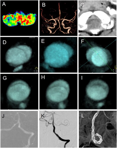 Figure 1. Treatment of cryptogenic vascular dissection related to neurodevelopmental disorders presenting with autism spectrum disorder. Hypoperfusion in the left cerebellar hemisphere (A), but with normal intracranial vertebral artery morphology (B). The vertebral artery dilates at the entry site, with a diameter of 5.7mm (C); two sequential DCE-CTs showed progressive morphological changes over different periods at the same location (D–F vs G–I); (J–L) the left cryptogenic vascular dissection was reconstructed using a stent.