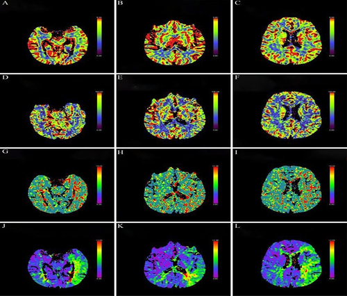 Figure 4 Representative case. Preoperative computed tomography perfusion (CTP) imaging of a 65-year-old male patient with repeated weakness of the right limb for more than 2 months. The cerebral blood volume (CBV) of bilateral cerebral hemispheres is equivalent (A–C), the cerebral blood flow (CBF) of bilateral cerebral hemispheres is equivalent (D–F), the mean transit time (MTT) of the left cerebral hemisphere is longer than that of the right (G–I), and the time to top (T-Max) of the left cerebral hemisphere is longer than that of the right (J–L).