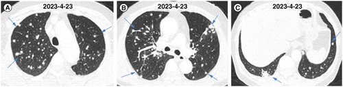 Figure 1. The chest computed tomography images of the patient at the first visit. (A–C) CT images of different transverse sections.CT: Computed tomography.