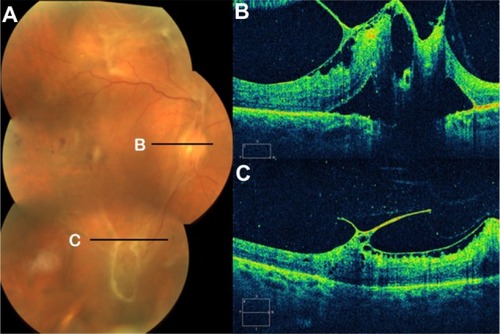 Figure 33 (A) Fundus photography, (B) fibrovascular proliferations of the optic disc (B-line), and (C) Cirrus™ optical coherence tomography of proliferative diabetic retinopathy with retinal traction and tractional detachment (C-line).