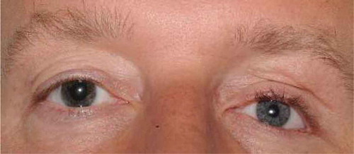 Figure 6. Last follow-up 1.5 years postoperative with Restylane fillers.