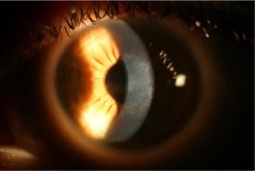 Figure 4 Right eye 6 months post-op showing diffuse anterior stromal haze without the central dense opacity.