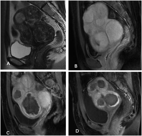 Figure 2. MRI obtained from a 32-year-old patient with DUL. (A and B) the T2WI and contrast-enhanced imaging revealed an enlarged uterus Filled with innumerable perfused fibroid nodules in each layer of the uterus before HIFU treatment. (C) MRI obtained one day after the first HIFU treatment show no enhancement of the leiomyomas at anterior uterine wall. (D) MRI obtained one day after the second HIFU treatment show no enhancement of leiomyomas at both the anterior and posterior walls of the uterus.