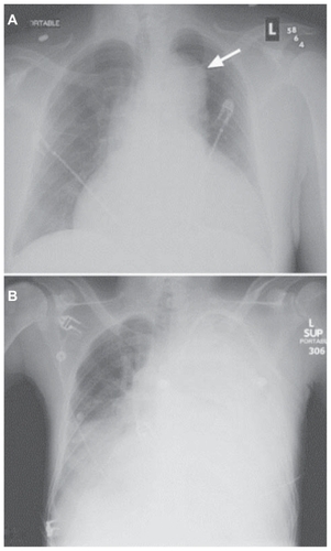Figure 3 Chest X-ray of a patient with diagnosed AoD. (A) Widened mediastinum, abnormal aortic contour and enlarged cardiac silhouette. (B) Acute left hemothorax after ruptured AoD dissection.This figure was published in Braunwald’s heart disease – a textbook of cardiovascular medicine, 9th ed. Bonow RO, Mann DL, Zipes DP, Libby P. Reproduced with permission, Copyright Elsevier (2012).