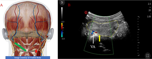 Figure 2 Anatomical structure of the oblique capitis inferior (OCI) and the picture of ultrasound-guided C2 dorsal root ganglion. (A) Coronal view of the OCI and ventral ramus of the C2 cervical nerve. Green rectangle in subfigure A inferior oblique cephalic muscle. Red arrow in subfigure A C2 dorsal root ganglion. (B) Virtual anatomical structure of C2 dorsal root ganglion PRF target. C2= C2 spinous process. C1= C1 transverse process. Arrow head: vertebral artery. Yellow dotted circle and green rectangle: oblique capitis inferior. Yellow and red arrow: the target area of C2 dorsal root ganglion with PRF. White arrow in subfigure B vertebral artery. Yellow arrow in subfigure B C2 dorsal root ganglion. Yellow dotted circle: inferior oblique cephalic muscle. C2 in subfigure B C2 spinous process. C1 in subfigure B C1 transverse process.