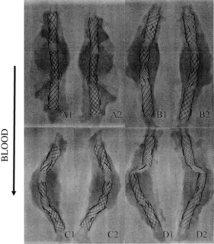 Figure 14 Different shapes of the stent-grafts after explantation and fixation in formaline; A1, A2) representative specimens of 12 straight devices; B1, B2) representative specimen of 12 slightly bent devices; C1, C2) representative specimen of 4 bent devices; D1, D2) sole misaligned device.