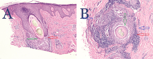 Figure 4 (A) Hematoxylin and eosin stain of the vertical section of an NAS biopsy specimen showing PIILIF. Shows a follicle with lichenoid inflammatory cell infiltrate composed of lymphocytes and plasma cells effacing the dermal-epidermal junction at the level of the infundibulum (Red arrow). There is basal squamatization associated with a Max-Josef space (Green arrow). The interfollicular epidermis is spared of inflammation. Perifollicular and interfollicular fibrosis is present. No sebaceous glands or Vellus or miniaturized hairs are present. Magnification 4x. (B) Hematoxylin and eosin stain of the horizontal section of the same NAS biopsy specimen showing PIILIF. Shows perifollicular inflammatory cell infiltrate composed of lymphocytes and plasma cells effacing the dermal-epidermal junction (Red arrow), basal desquamatization associated with a Max-Josef space (Green arrow), and perifollicular fibrosis (Blue arrows). Magnification 4x.