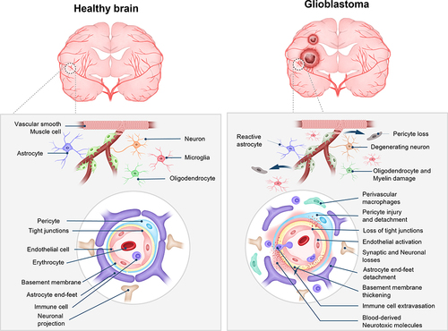 Figure 1 Differences between the blood-brain barrier (BBB) of a healthy brain and the blood-brain tumor barrier (BTB) of glioblastoma.
