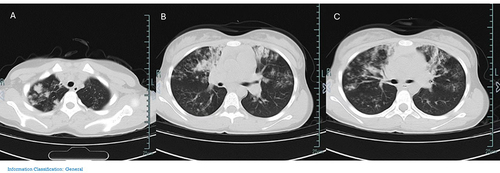 Figure 1 (A–C) Chest CT on the first day of admission: multiple flaky, cloudy lungs with increased density and blurred edges.