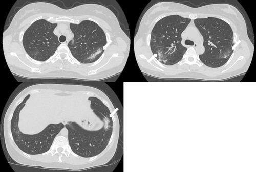 Figure 2 CT scans showed bilateral patchy consolidation surrounded by ground-glass opacity (white arrow).
