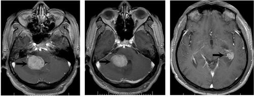 Figure 1 MRI scan of the brain at presentation. This MRI scan image showed two notable nodules in the cerebellopontine angle area and the medial temporal horn of the left ventricle (black arrow).