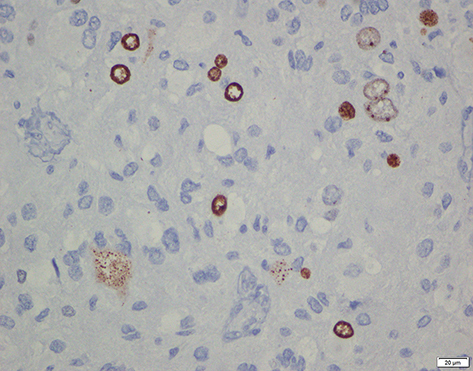 Figure 5 Immunohistochemistry staining for Ki67 (glioblastoma) showed medium expression.