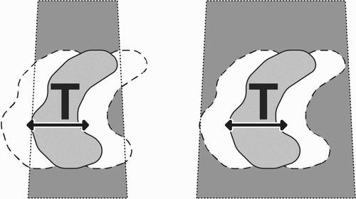 Figure 2. Tumor motion may result in partial underdosage. Without motion compensation, a margin is required. This leads to a substantial increase in integral radiation dose.