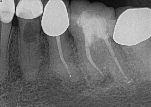 Figure 40. 8 months recall by general dentist, showing signs of healing and noticeable invasive cervical resorption on tooth #21.