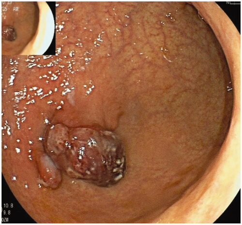 Figure 4. GHPs with well-differentiated carcinoma in the corpus were arisen from AMAG.