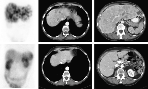 Figure 3.  Example of partial remission in a patient with a metastasised carcinoid treated with 29.8 GBq [177Lu-DOTA0,Tyr3]octreotate. Upper row: left panel: scintigraphy (anterior abdomen) after first cycle with [177Lu-DOTA0,Tyr3]octreotate demonstrated extensive somatostatin receptor positive liver metastases. Middle and right panel: CT scan before starting treatment demonstrated these liver metastases. Lower row: left panel: scintigraphy (anterior abdomen) after fourth cycle with [177Lu-DOTA0,Tyr3]octreotate could not visualise liver metastases anymore. Middle and right panel: CT scan after treatment still demonstrated multiple small liver metastases, but metastases clearly regressed in size.