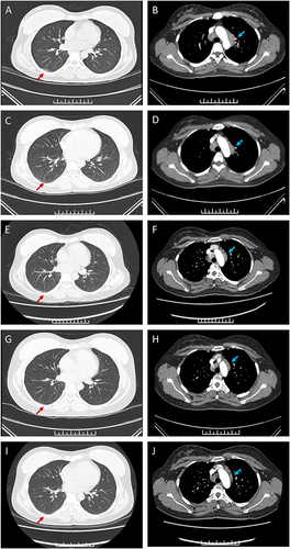 Figure 2 Enhanced chest CT scanning of the patient. Chest CT enhancement showed bilateral interstitial pneumonia especially the right lower lobe under pulmonary window (A) and multiple mediastinal lymphadenopathies under mediastinal window (B) on hospital Day 2. Chest CT enhancement showed pneumonia of right lower lung was getting smaller under pulmonary window (C) but mediastinal lymphadenopathies were the same under mediastinal window (D) on hospital Day 7. Chest CT enhancement showed the interstitial changes of both lungs were further improved under pulmonary window(E) and the enlarged lymph nodes began to shrink under mediastinal window (F) one month later. Chest CT enhancement showed pneumonia of right lower lung was getting much smaller under pulmonary window (G) and mediastinal lymphadenopathy were getting smaller under mediastinal window (H) two months later. (I) Chest CT enhancement showed pneumonia of right lower lung disappeared under pulmonary window and mediastinal lymphadenopathy were getting much smaller under mediastinal window (J) on the follow-up of 141th days. (Red arrow: interstitial pneumonia, blue arrow: mediastinal lymphadenopathy).
