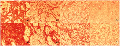 Figure 7. Histopathological images with Sirius red staining of uterine fibroids with different signal intensities on T2-weighted MRI. (A) Hypo-intense; (B) Isointense; (C) Heterogeneous intense and (D) Homogeneous hyper-intense. A1–D1: microscopic magnification, × 100; A2–D2: microscopic magnification, × 400.