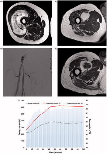 Figure 4. The representative case. A 64-year-old male patient was initially diagnosed with solitary fibrous tumor in the vastus femoris ([a] MRI T1WI, with gadolinium enhancement) and underwent wide resection 1 year ago. During the follow-up period, the recurrence of tumor was found around the femoral artery ([b], MRI T1WI, with gadolinium enhancement). Then, the RHC was performed for the recurrent tumor. The area of irradiation was determined by the radiologist with coverage of the prior surgical area. IA chemotherapy was administered from the catheter placed in the superficial femoral artery (c). The evaluation of thermal effect was mild (42.5 °C achieved in 3/5 RHC cycles). An example of thermal therapy is depicted in (d). Although the tumor size remained the same, the intake of tracer was attenuated (e). Then, a repeat wide resection was performed. Five years after surgery, the patient was still alive with no evidence of the disease.