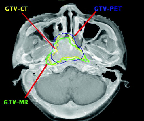 Figure 1.  GTV-CT, GTV-MR and GTV-PET on blended CT/MR image