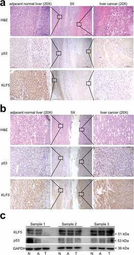 Figure 6. Expression of KLF5 is lost in invasive liver cancer. (a). In liver cancer with metastasis, p53 and KLF5 were both lost in the tumor tissue compared with the adjacent normal liver tissue. (b). In liver cancer without metastasis, although p53 was mutated in the tumor tissue, the expression of KLF5 was still positive in the tumor tissue compared with the adjacent normal liver tissue. H&E (hematoxylin and eosin) staining was used to identify the tumor tissue and adjacent normal liver tissue. Scale bars = 500 µm (5×) and 100 µm (20×). (c). The expression levels of KLF5 and p53 in three liver cancer samples (sample 1, sample 2 and sample 3) were examined by western blotting. In a sample with metastasis, KLF5 and p53 were both lost in the tumor tissue (T) compared with normal (N) and adjacent normal liver tissue (A), while in the samples without metastasis, the expression of both KLF5 and p53 was detected.