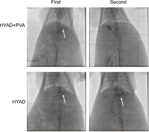 Figure 5 DSA of VX2 liver tumor rabbit model.Notes: After the tumor matured, in treatment groups requiring PVA embolization, under fluoroscopic guidance, about 0.5 mL PVA particles in 100–300 µm size of mixture were injected into the blood supplying arteries of tumor in each rabbit, and the embolization ended as antegrade blood flow was completely static. One week later, groups A and B took a second injection of HYAD with 1×109 PFU (1 mL PBS dilution). At first intervention in groups A and B, contrast dyeing of neoplasm was obvious after injecting contrast agent (marked by white arrow). One week later, because of PVA embolization, contrast dyeing of neoplasm could not be seen in group A but could be seen in group B.Abbreviations: DSA, digital subtraction angiography; HYAD, hypoxia-replicative oncolytic adenovirus; HYAD+PVA, HYAD combined with PVA particle embolization; PVA, polyvinyl alcohol.