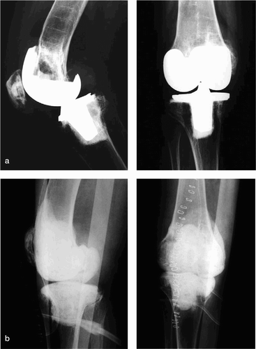 Figure 3. An articulating spacer reconstructs a femoral segmentary defect (b) after removal of an infected total knee (a).