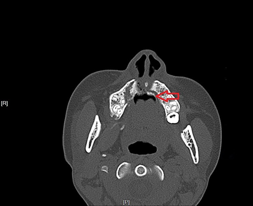 Figure 2 CT showed the palatal perforation (red arrow).