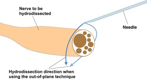 Figure 10 Relative direction and movement of the needle when using method 2 for hydrodissection (HD) of nerves. This shows the initial out-of-plane portion of method 2 with HD of the nerve on either side until injectate is seen surrounding the nerve, at which point the probe position is changed to in-plane with the nerve to HD the space above the nerve.
