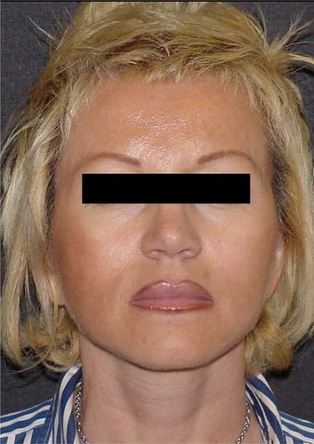 Figure 7 Appearance 10 days postoperatively in frontal view.